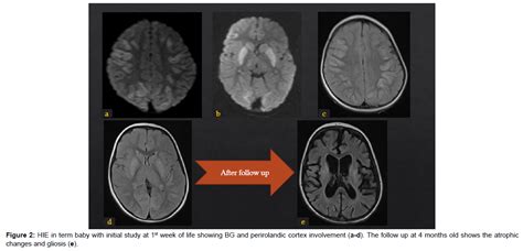 Journal Of Radiology Hypoxic Ischemic Encephalopathy Mri Findings And