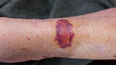 Thrombotic Thrombocytopenic Purpura Rash