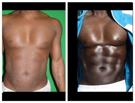 Abdominal Sculpting Liposuction For Men London Hans Place Practice