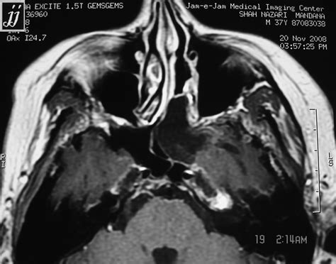 Sphenoidal Sinus Retention Cyst Radiopaedia