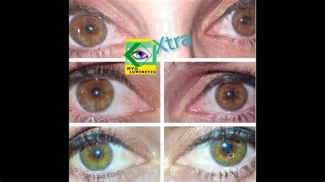 Chirurgie De Changement De Couleur Des Yeux Au Laser