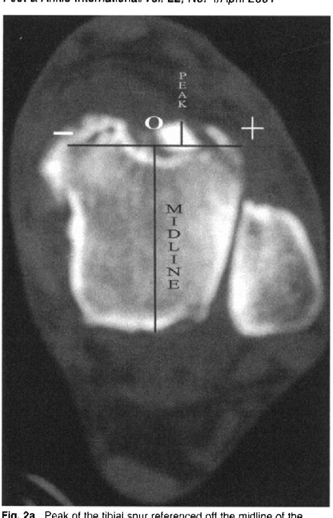 Figure 2 From Morphology Of Tibiotalar Osteophytes In Anterior Ankle