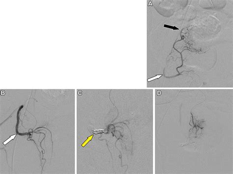 Rectal Artery Embolization For Hemorrhoidal Disease Anatomy