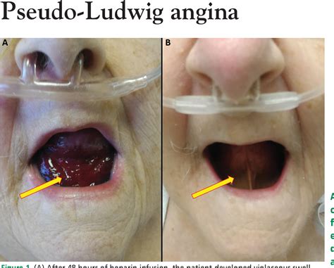 Figure 1 From Pseudo Ludwig Angina Semantic Scholar