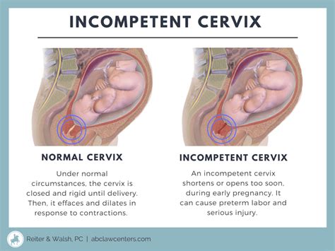 Signs And Symptoms Of Incompetent Cervix Abc Law Centers Birth