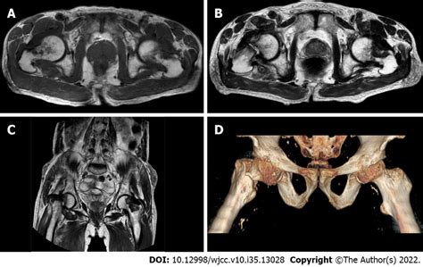 Case 2 Hip Magnetic Resonance Imaging And 3d Imaging A Femoral Neck