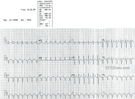 Sinus Tach Vs SVT EKG