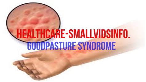 5 Goodpasture Syndrome Solutions You Can Try Today - YouTube