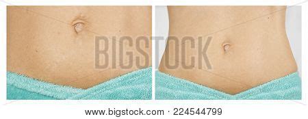 Female Abdomen Before Image Photo Free Trial Bigstock