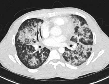 Peribronchovascular Consolidation Radiology Reference Article