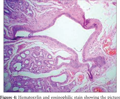 Figure 5 From A Typical Clinical Presentation Of Oral Mucocele