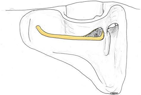 Temporal Bone Fracture Requiring Facial Nerve Decompression Or Repair