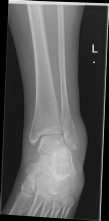 Weber classification of ankle fractures | Radiology Reference Article ...