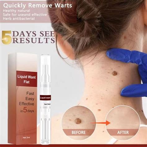 Mole Warts Remover Original Cream Painless Effective Warts Removal Skin