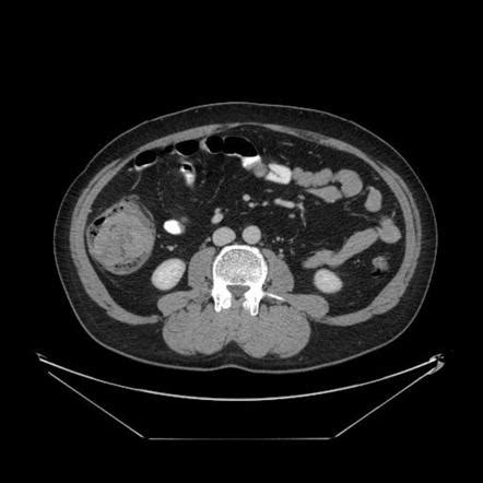 Colorectal Carcinoma Radiology Reference Article Radiopaedia Org