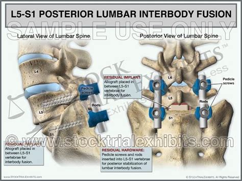 Posterolateral Fusion Surgery