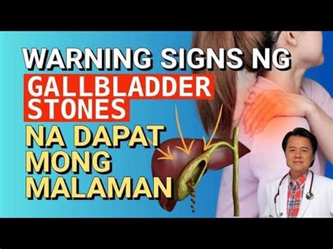 Warning Signs Ng Gallbladder Stone Bato Sa Apdo Na Dapat Mong Malaman