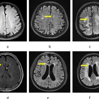 Neuroimaging Characteristics Of White Matter Hyperintensity Wmh In