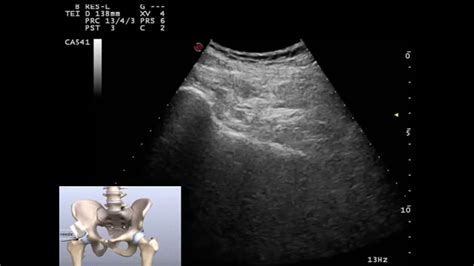 Hip Joint Injection Ultrasound