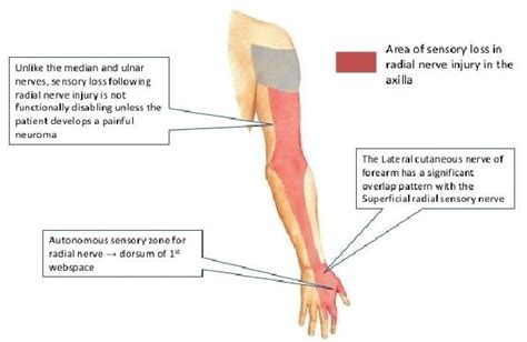 Wrist Drop By Gavin Giovannoni Teach Neurology