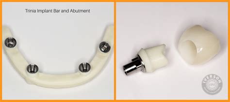 Trinia Metal Free Implant Bars And Abutments