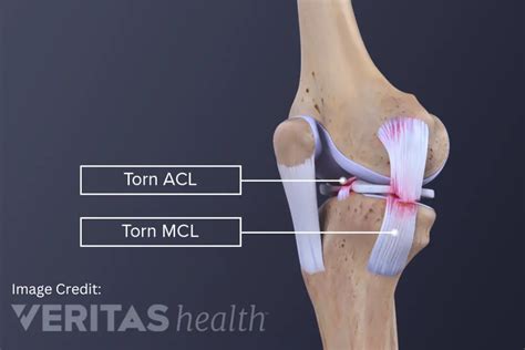 What Is The Difference Between An Acl Tear And An Mcl Tear 44 Off