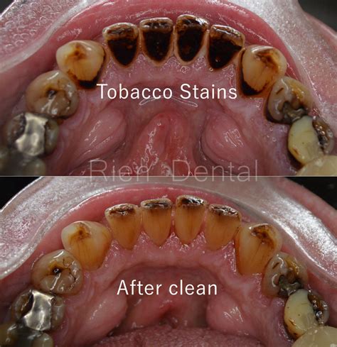 Chewing Tobacco And Teeth At Henry Soler Blog