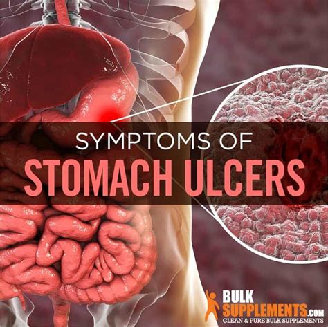 Stomach Ulcers: Causes, Symptoms, Home Remedies & Treatment