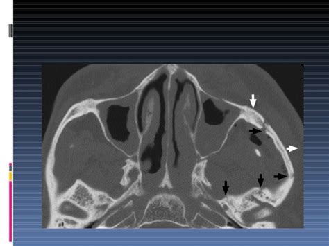 Ct Of Maxillofacial Trauma