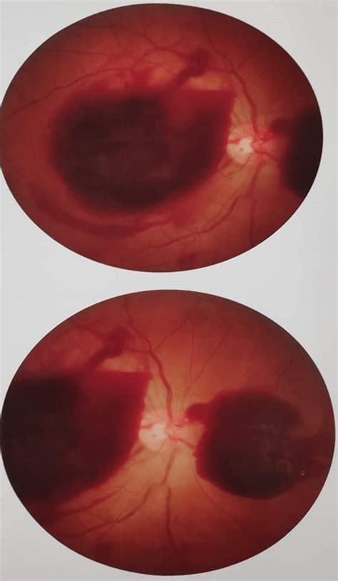 Fundoscopy Shows Retinal Hemorrhage Download Scientific Diagram