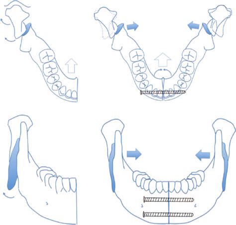 A B Condylar Rotation During Mandibular Setback Caused By Lateral Download Scientific Diagram