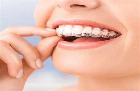 Invisalign In Valdosta Ga The Clear Choice For Straighter Smiles