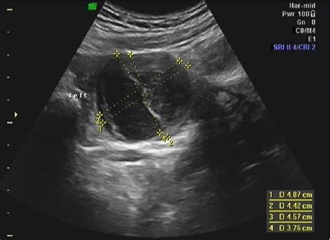 adnexal cyst | Semantic Scholar