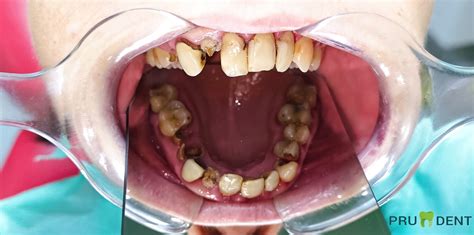 Cazuistica Before After Stomatologie Brasov Pru Dent