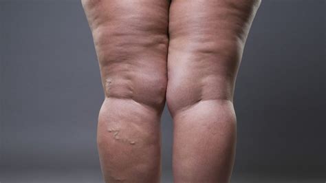 Lipedema O Que Sintomas Tratamento E Como Prevenir Total Vascular