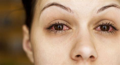 These Home Remedies for Eye Infection Work Amazing!