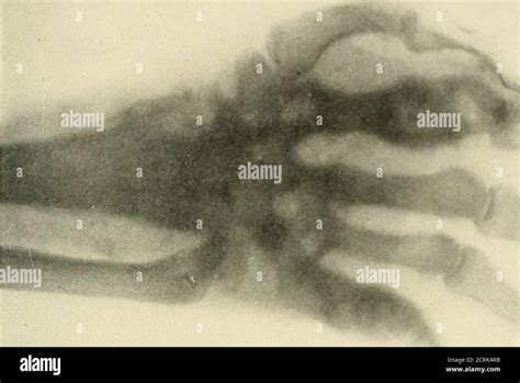 Necrosis finger hi-res stock photography and images - Alamy