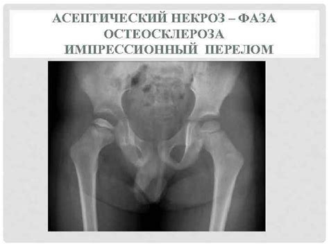 НЕКРОЗЫ ГАНГРЕНЫ СВИЩИ ОСТЕОМИЕЛИТ ОСТЕОНЕКРОЗ омертвение