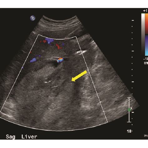 Postembolization Color Doppler Ultrasound Demonstrating Echogenic Download Scientific Diagram