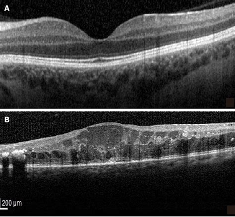 Disorganization Of The Inner Retinal Layers A Normal Optical