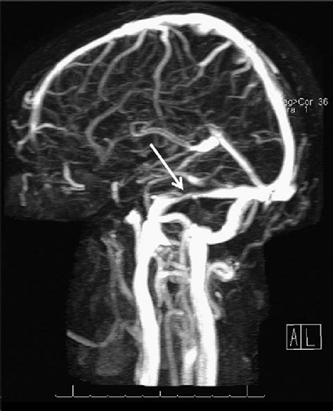 Magnetic Resonance Venogram Showing Smooth Walled Venous Stenoses Of Download Scientific