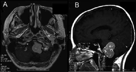 Intradural hypoglossal canal pathology. (A) Axial T1-weighted MRI with ...