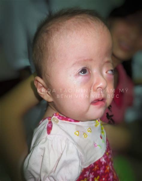 Điều Trị Thành Công Hội Chứng Hẹp Hộp Sọ Phức Tạp Aperts Syndrome