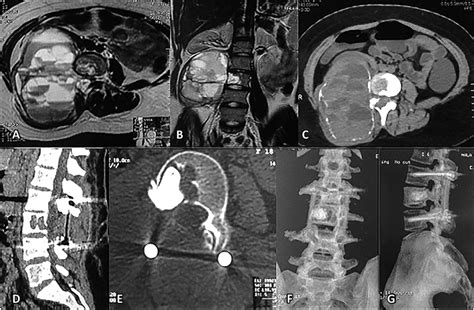 Preoperative T Mri Axial A And Coronal B Showing Large Mass