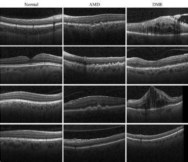 Retinal OCT Disease Classification | Papers With Code