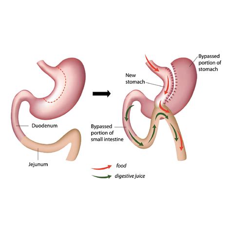 gastric  pass