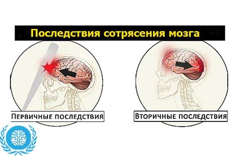 Легкое сотрясение мозга — Симптомы и методы лечения, советы врачей