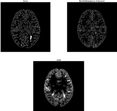 Figure 1 From Segmentation Of Multiple Sclerosis Lesion In Brain Mr Images Using Fuzzy C Means