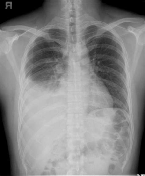 Chest X Ray Posteroanterior View Showing Right Sided Pleural Effusion