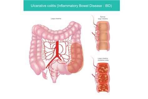 What To Expect After Being Diagnosed With Ulcerative Colitis